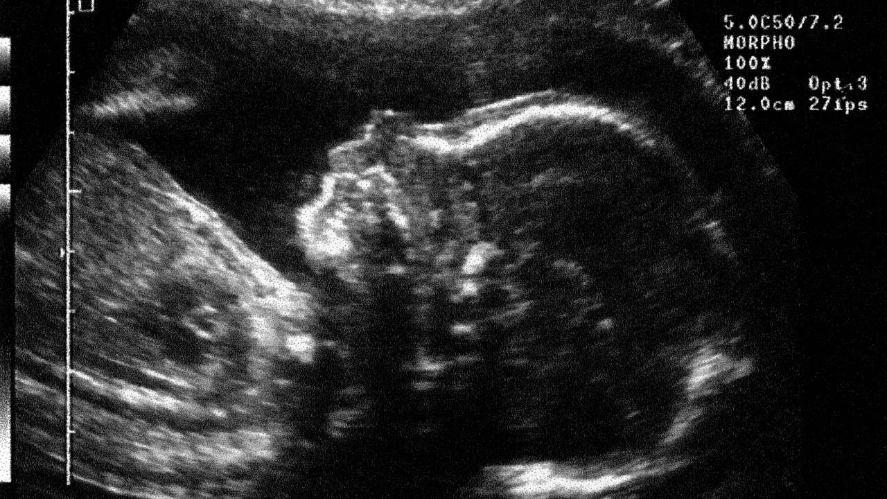 نجاح أول عملية جراحية على دماغ طفل داخل رحم أمه لمنع فشل القلب