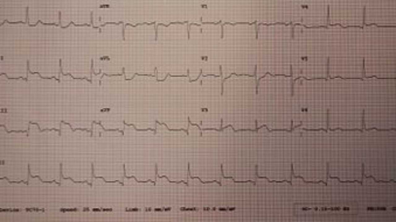 خطر زيادة السكتات القلبية في بداية أسبوع العمل: احذر يوم الاثنين!
