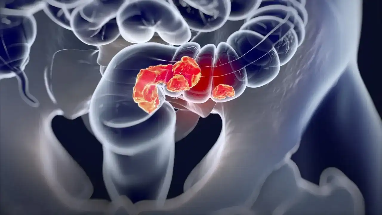 دراسة حديثة ترجئ ارتفاع معدلات الإصابة بسرطان القولون لدى الشباب لسوء نوعية الغذاء