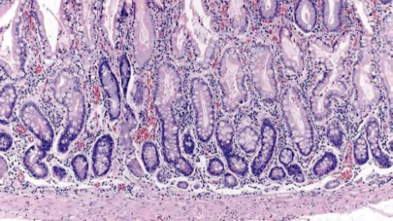 إلتهاب بطانة المعدة... أعراضه، أسبابه وعلاجه