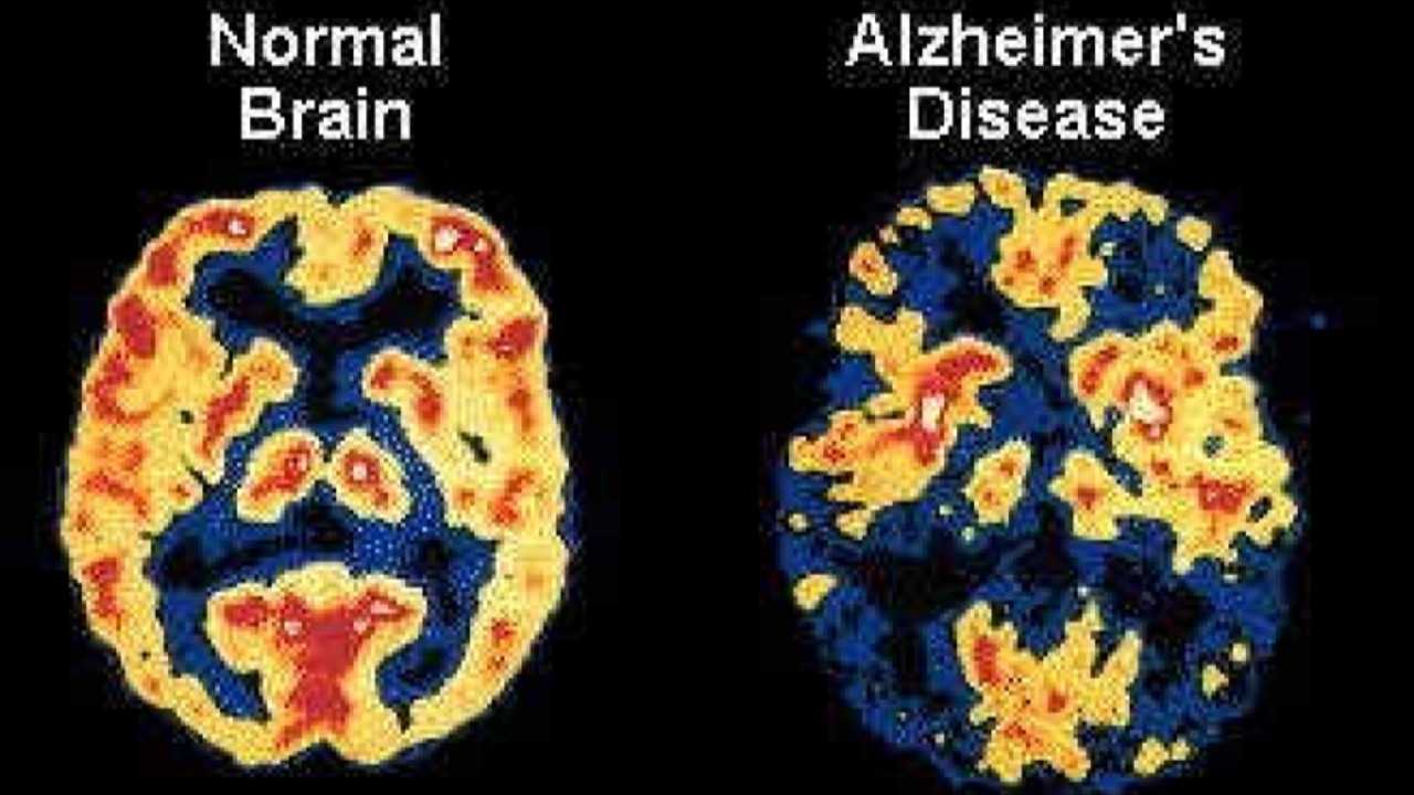عقار شركة أكيومن لعلاج ألزهايمر يجتاز اختبارًا أوليًا للسلامة
