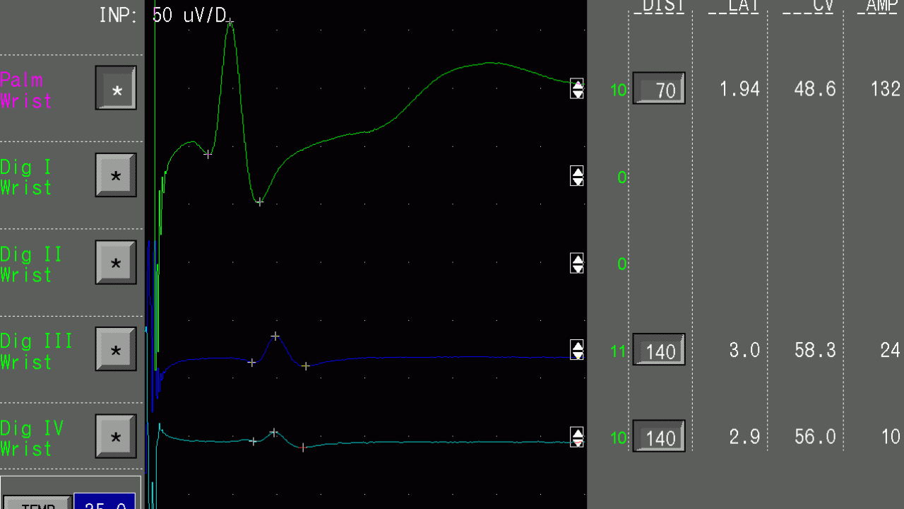 نجاح علاج غير جراحي للألم المزمن يشوش على إشارات الدماغ