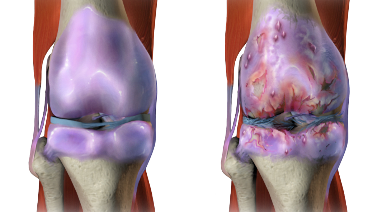تآكل المفاصل يؤثر على الشباب أيضاً كما العجائز عكس الشائع حسب أحدث الدراسات
