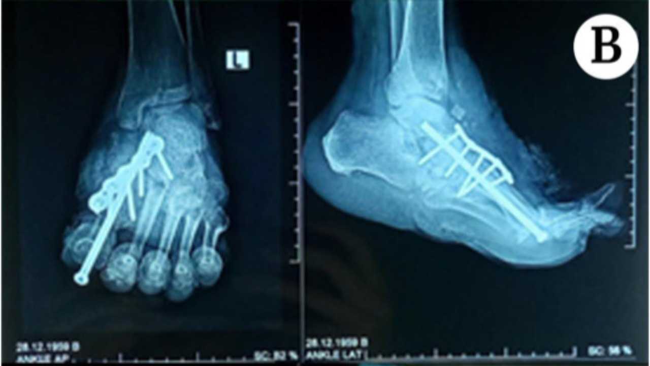 دراسة حديثة تتوصّل إلى علاج جديد واعد لمرض شاركو القاتل أو التصلّب الجانبي الضموري