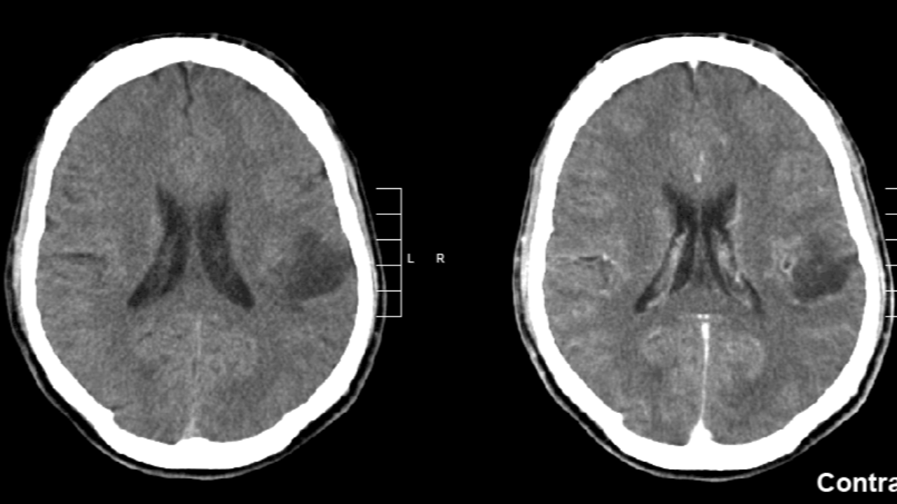 حالة نادرة لطفل يشفى من سرطان الدماغ تفتح آمالاً كبيرة للعلاجات المستقبلية