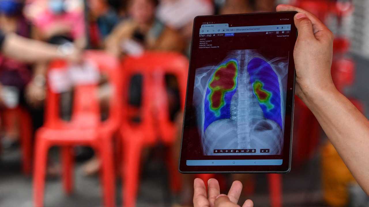 بعد سنوات من العلاجات الصعبة للسلّ... دواء جديد سريع المفعول يعيد الأمل بالشفاء للمرضى