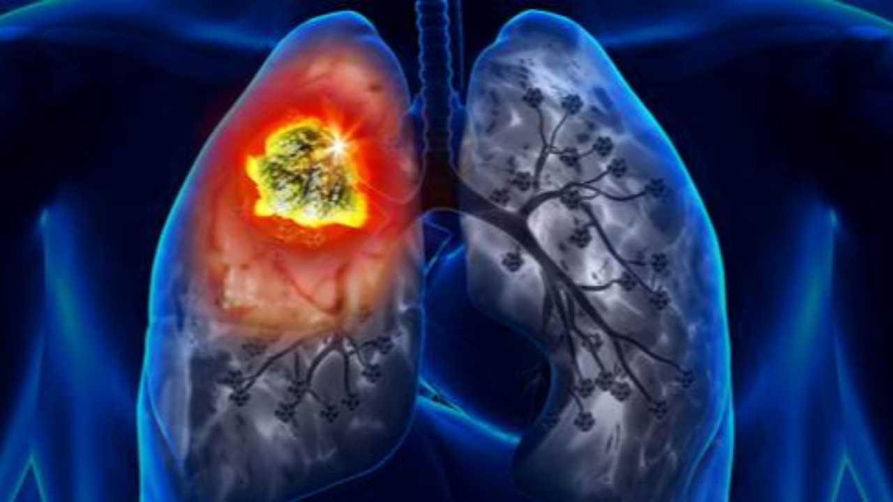 دراسة تكشف نتائج واعدة لعلاج سرطان الرئة المنتشر إلى الدماغ